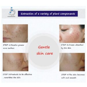 BIOAQUA Anti Acne Cleanser For Removal Of Acne - 100ml - Image 6