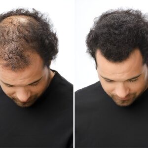 Toppik Hair Building Fiber Fuller Looking Hair for Men & Women (27.5g) - Image 10