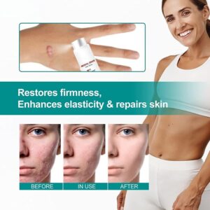 Scar Remove,Scar Remove Medical Grade Scar Spray,Medical Grade Scar Removal Spray,Scar Removal Spray,Scar Remove Spray,Scar Spray,Advanced Acne Scar Treatment for Face (1Pcs) - Image 4