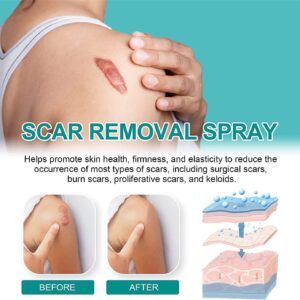 Scar Remove,Scar Remove Medical Grade Scar Spray,Medical Grade Scar Removal Spray,Scar Removal Spray,Scar Remove Spray,Scar Spray,Advanced Acne Scar Treatment for Face (1Pcs) - Image 9